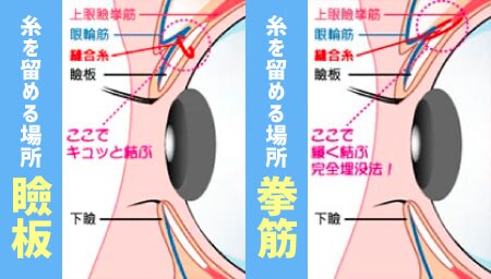 切らない手術!二重埋没法とは