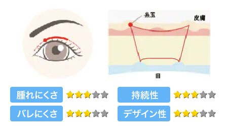 腫れづらいスクエア二重術