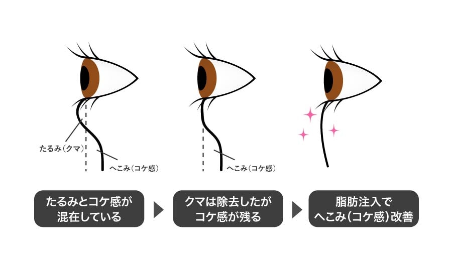 目の下の切らないクマ・たるみ取り×脂肪注入