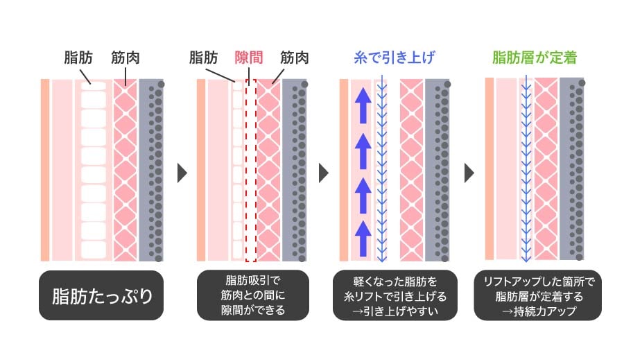 脂肪吸引注射×糸リフト