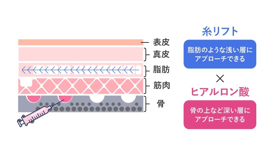 糸リフト×ヒアルロン酸