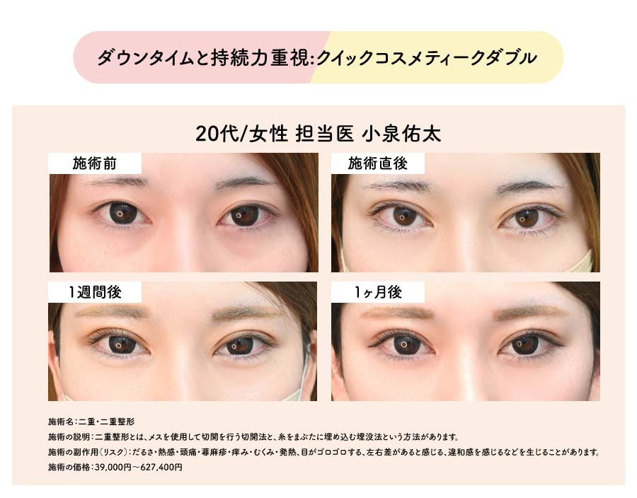 ダウンタイムと持続力重視:クイックコスメティークダブル