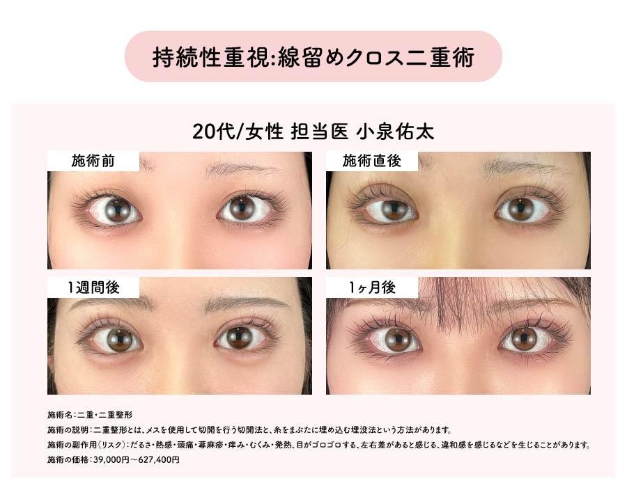 持続性重視:線留めクロス二重術