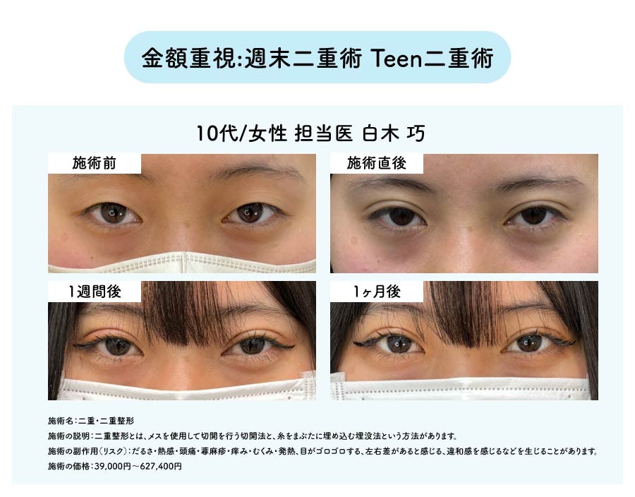 金額重視:週末二重術/Teen二重術