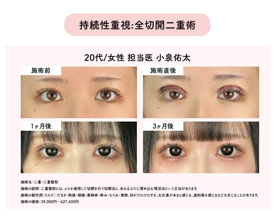 持続性重視:全切開二重術
