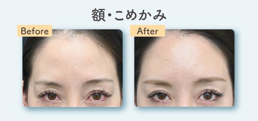 額・こめかみ
