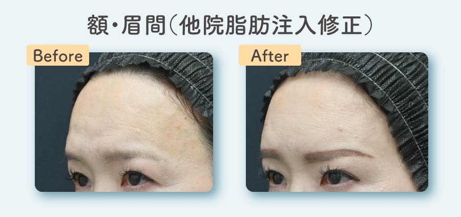 額・眉間