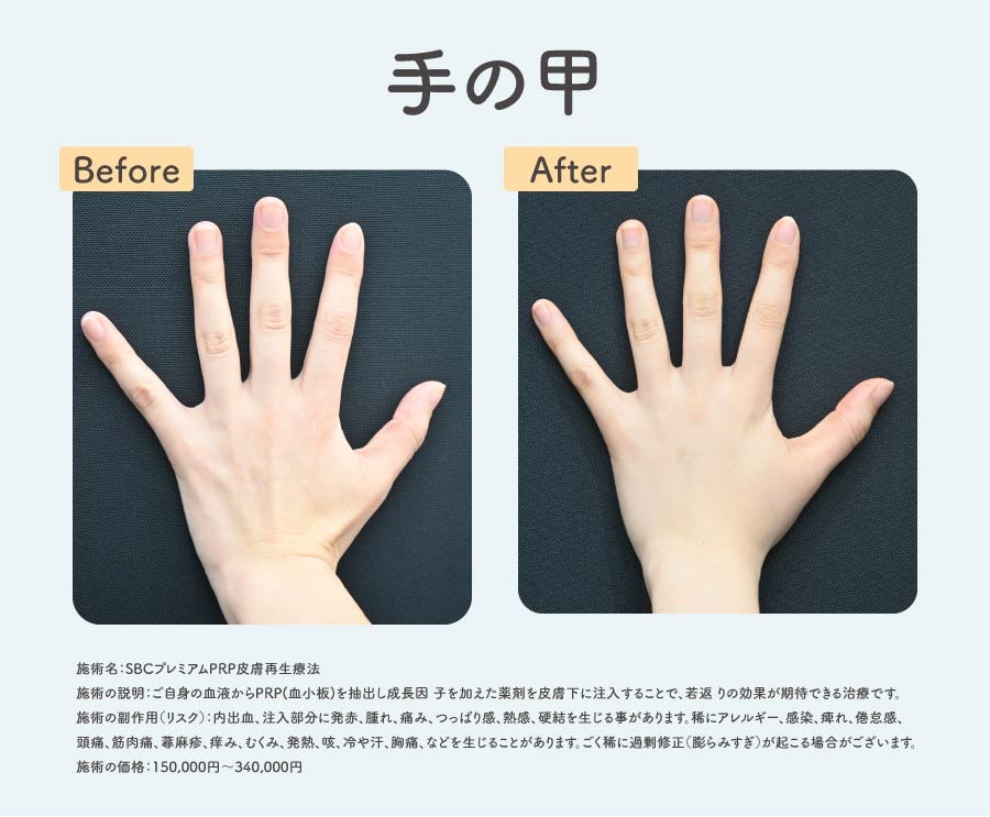 手の甲
