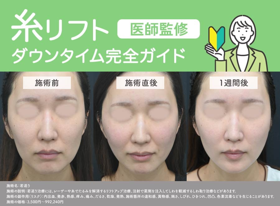 【医師監修】糸リフトのダウンタイム完全ガイド｜腫れ・内出血・痛み・NG行動まで徹底解説｜湘南美容クリニック浜松院