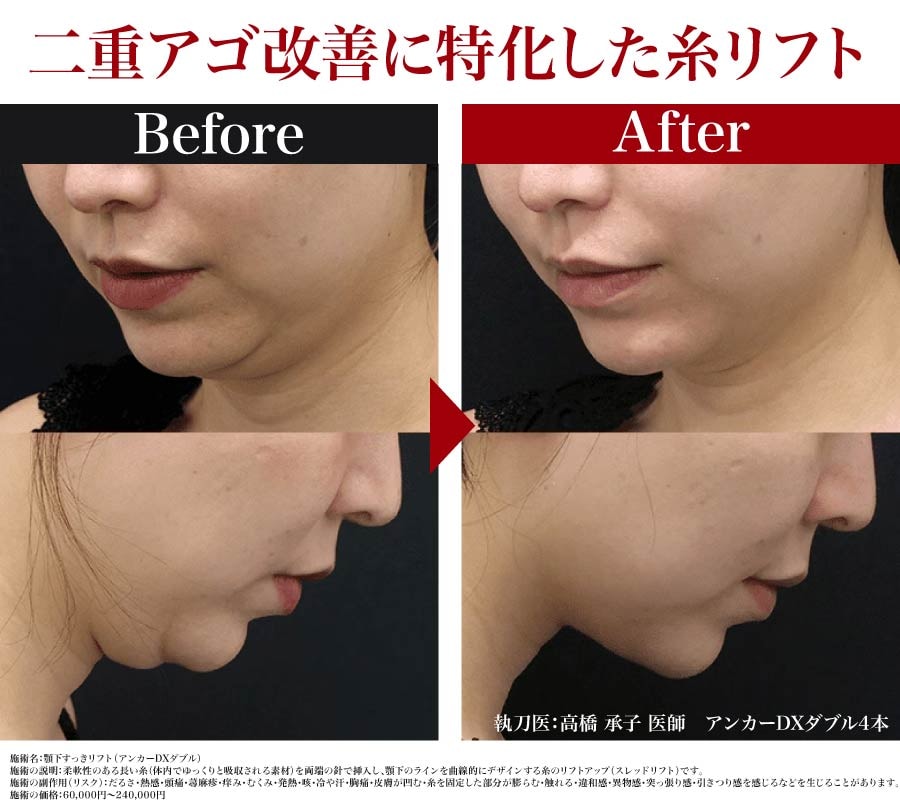 無理なく若返る新しいフェイスライン治療