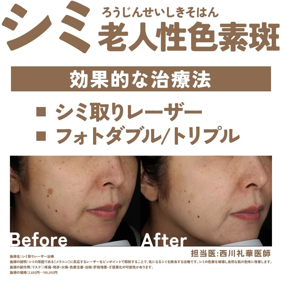 ①シミ（老人性色素斑）に効果的な治療