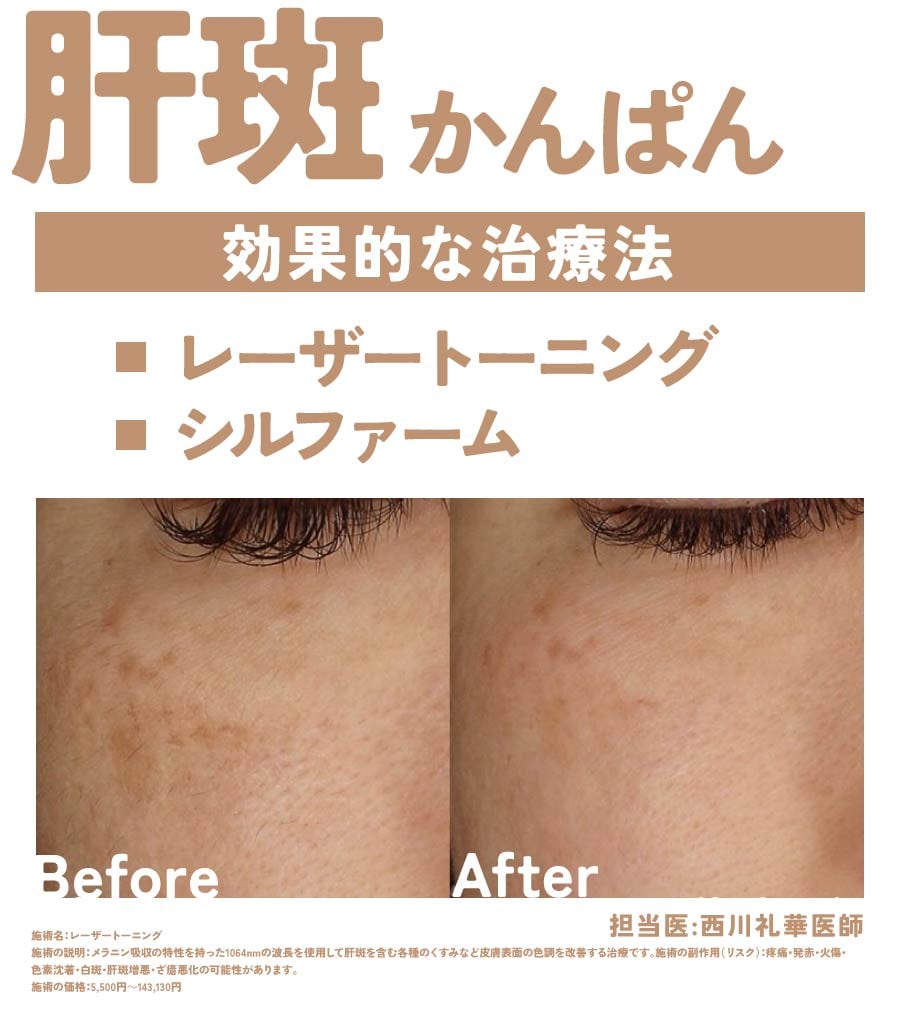 ③肝斑に効果的な治療