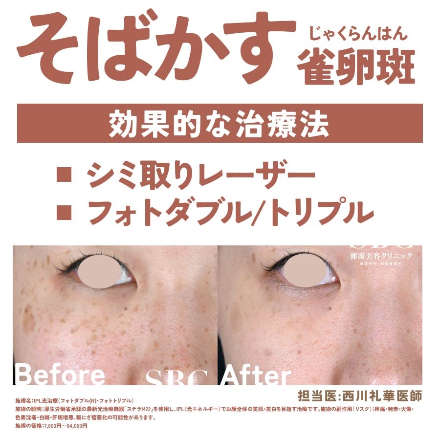 ②そばかす（雀卵斑）に効果的な治療