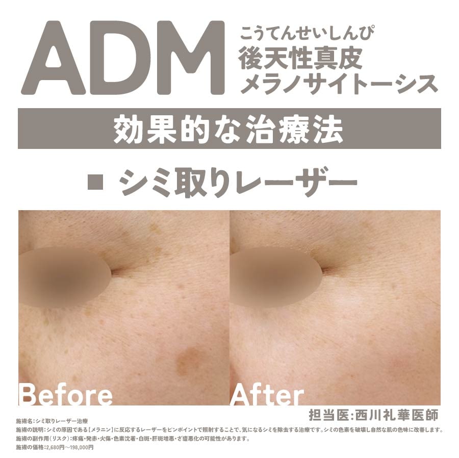 ④ADM（後天性真皮メラノサイトーシス）に効果的な治療