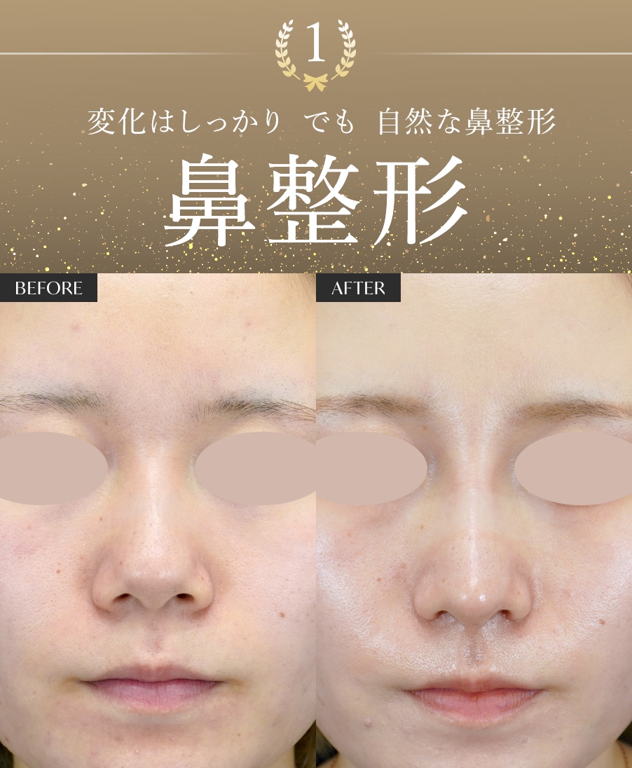 【鼻整形】なら本間医師にお任せ！変化はしっかり、だけど自然！確かな技術で華やかな美人鼻に仕上げます。