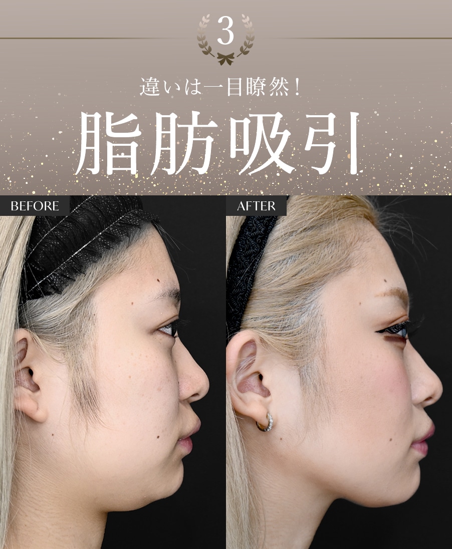 【脂肪吸引】なら本間医師にお任せ！あなたもキュッとたるみのない小顔になれるチャンス！