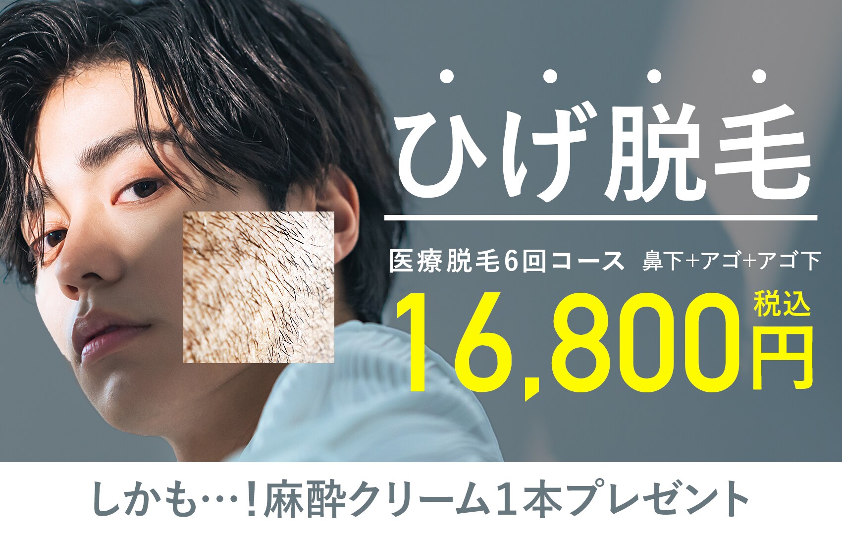 脱毛するならSBC原宿院【ヒゲ・もみあげ脱毛】がお得！しかも麻酔クリーム1本プレゼント！