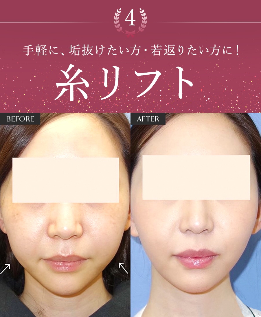 【糸リフト】気軽な若返り・垢抜け！年代問わず・スタッフからも大人気♪