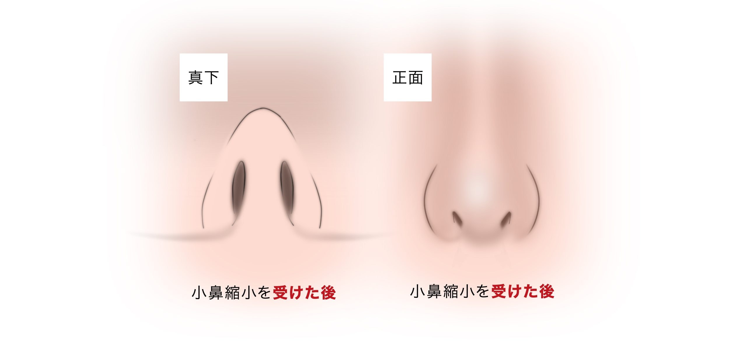 コンセント鼻