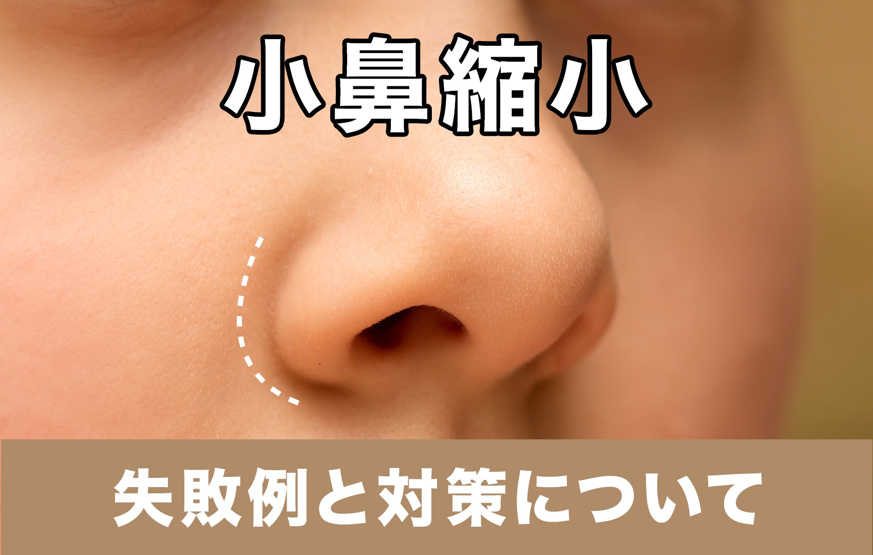 【小鼻縮小】ちょっと待って！失敗例と対策について医師が解説。湘南美容クリニック原宿院(東京・渋谷)