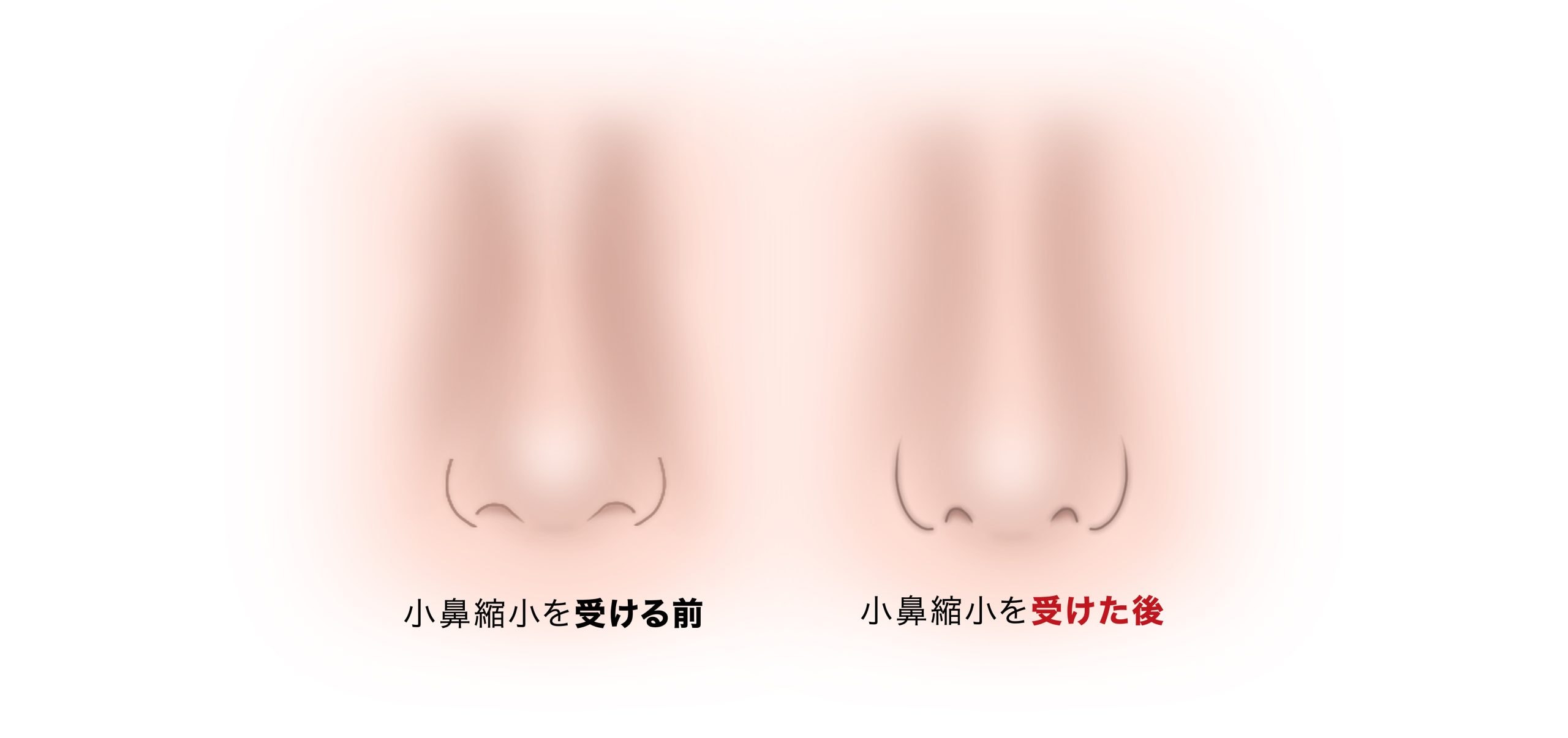 摘んだような鼻に