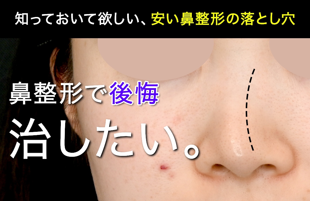【鼻整形で後悔】安い鼻整形の落とし穴とは？修正症例と医師の本音｜湘南美容クリニック本間院長が解説