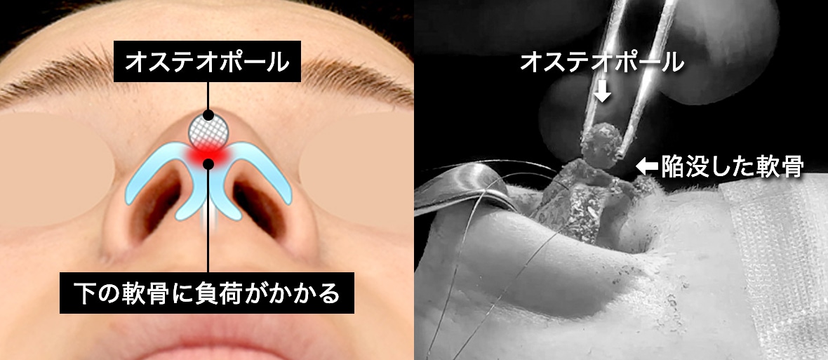 オステオポールとは？