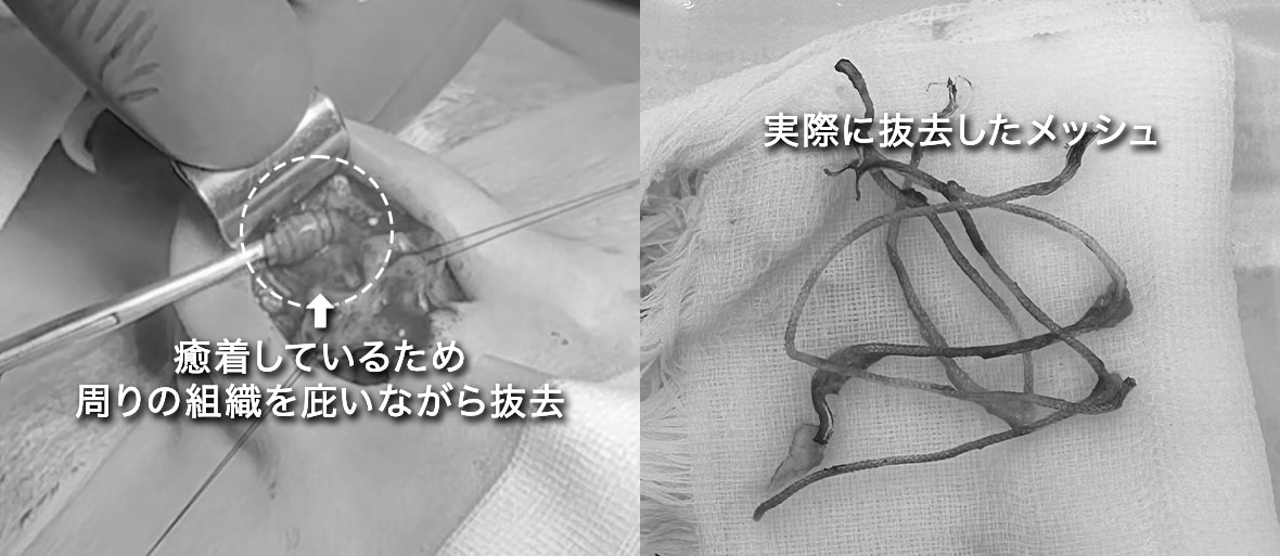 Gメッシュとは？