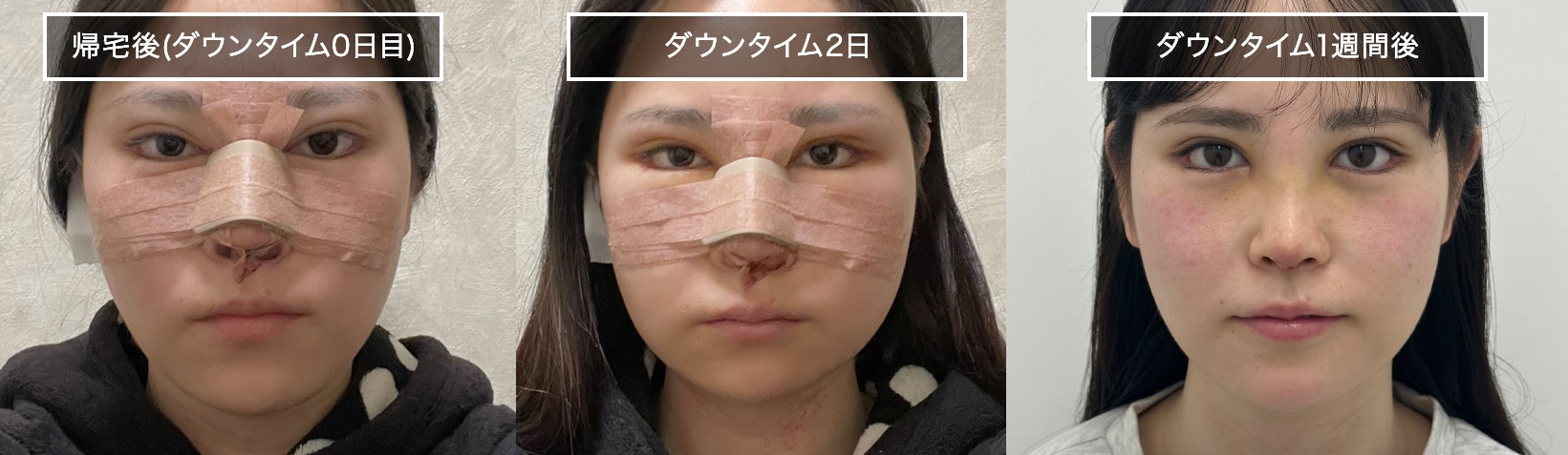 どのくらい腫れる？