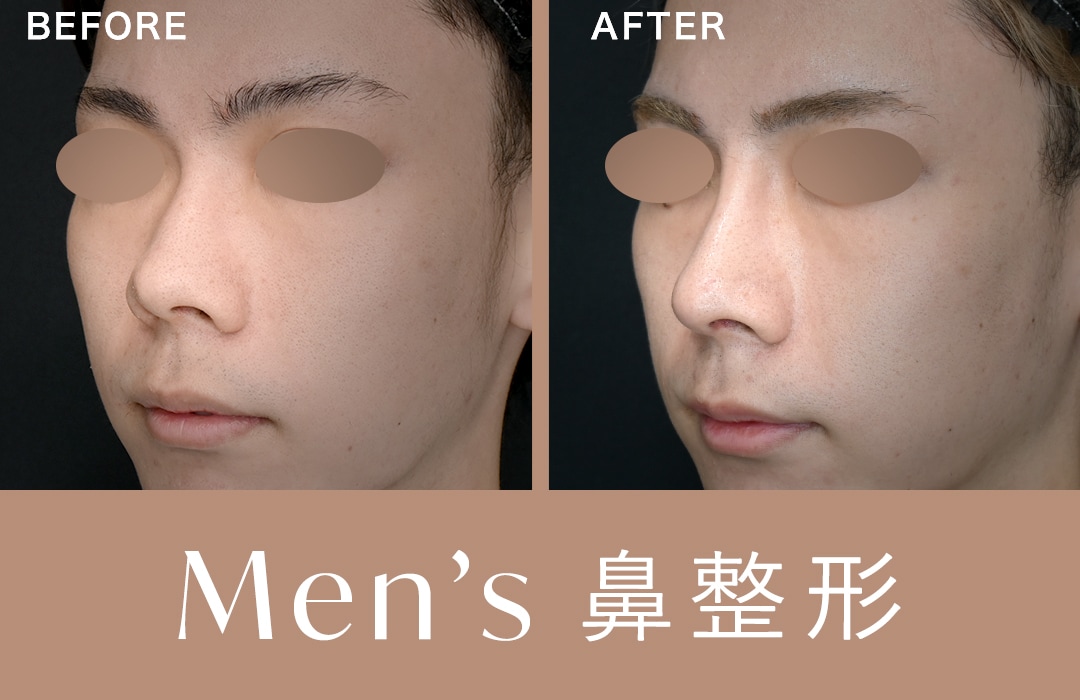 【男性の鼻整形】「顔に似合う自然な鼻に」費用・症例についてご紹介
