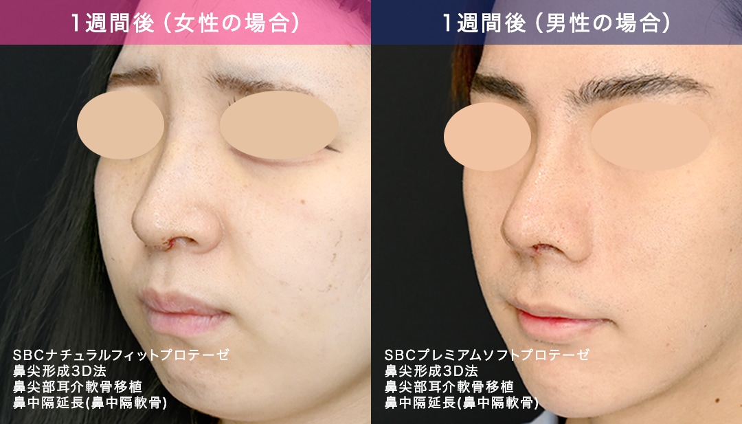 男性は腫れやすい？