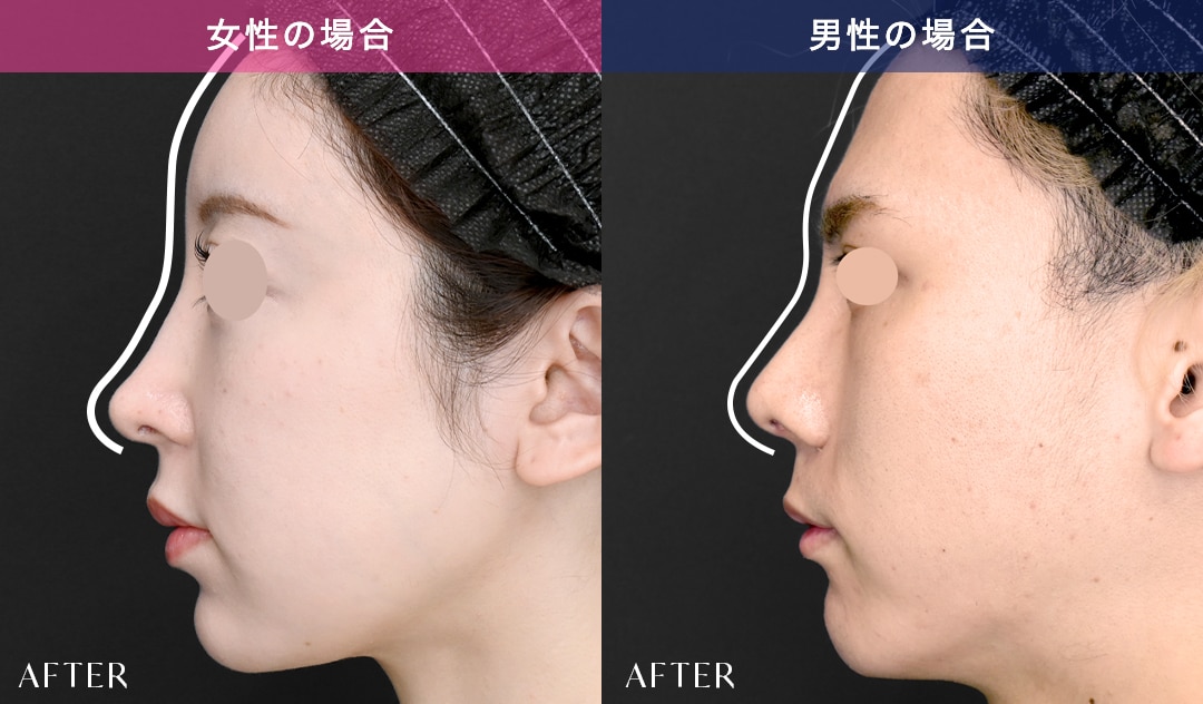 男性に似合う鼻整形