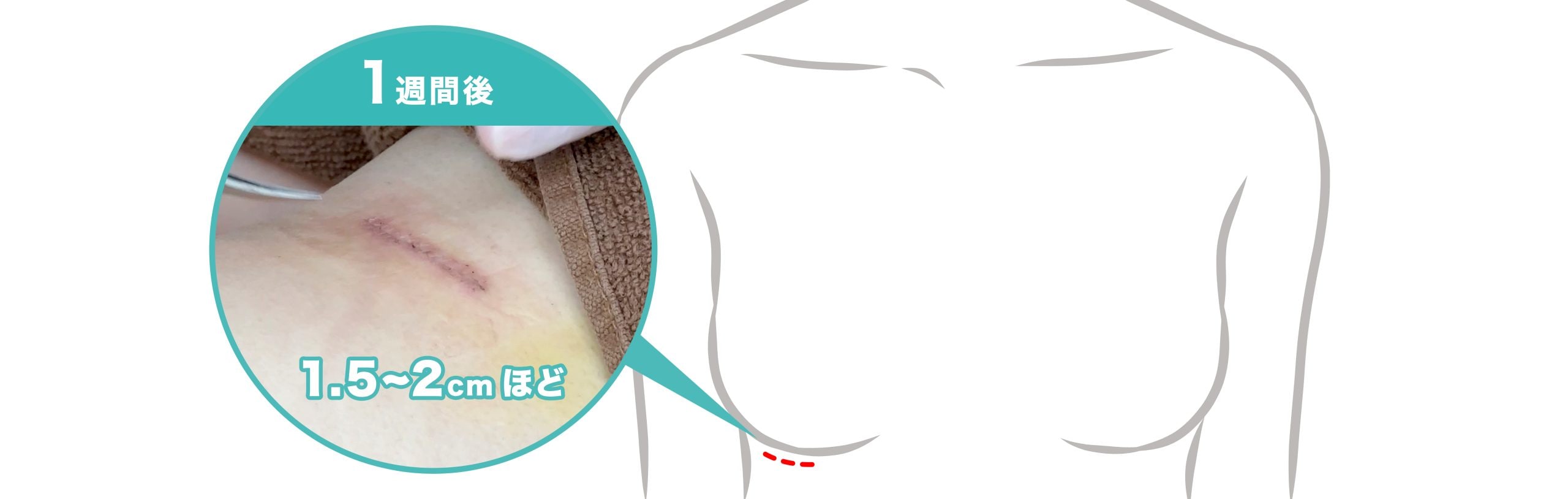 肋軟骨採取箇所