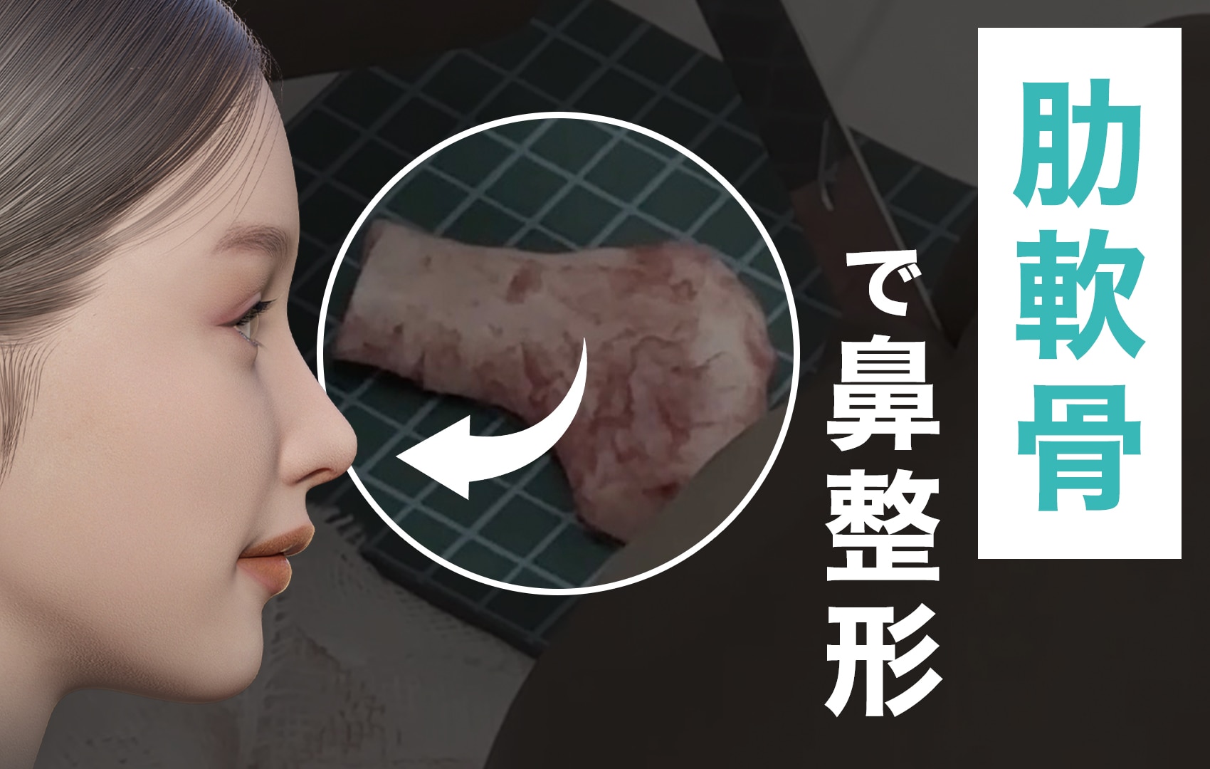 【肋軟骨の鼻整形】料金はいくら？痛み・ダウンタイムを徹底解説