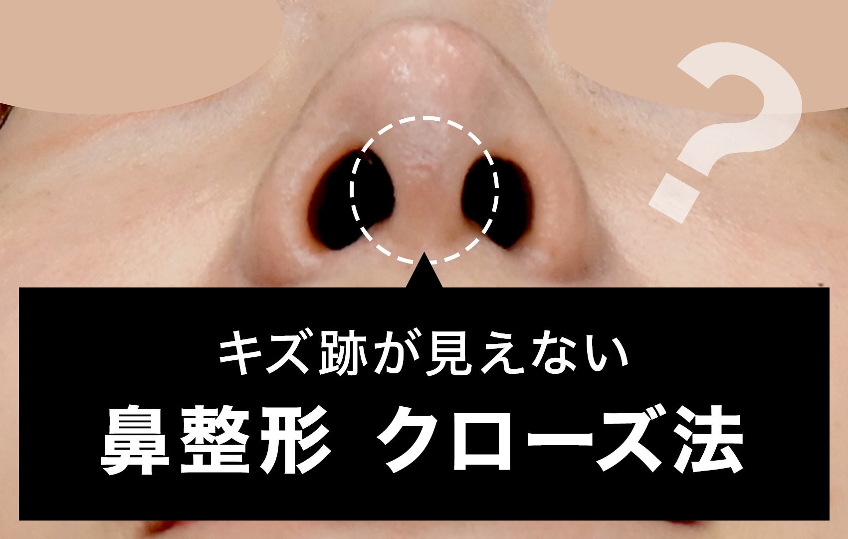 【鼻整形】クローズ法とオープン法の違いとは