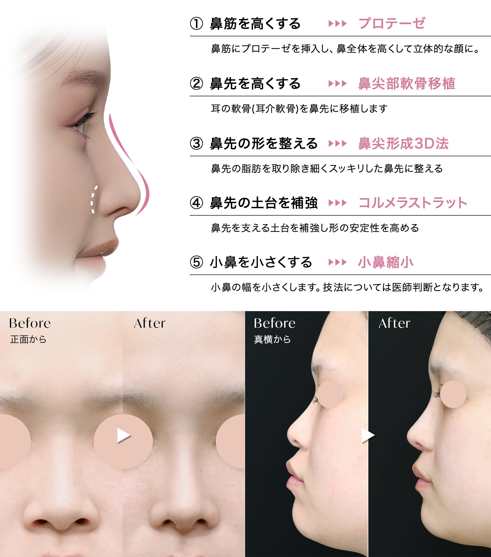 鼻フル忘れ鼻セット