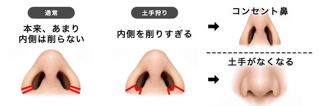小鼻を削りすぎる