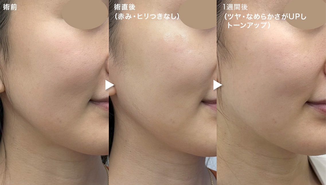 術直後の赤みなし