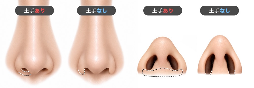 土手あり・なし