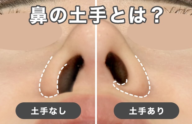 【鼻整形】小鼻縮小で土手が(鼻腔底隆起)がなくなる?「土手狩り」とは?|湘南美容クリニック原宿院(東京・渋谷)