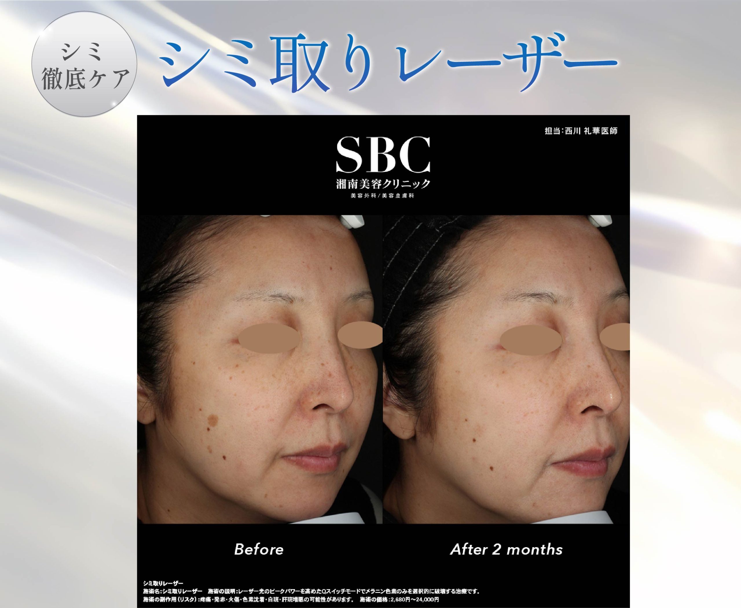 1.シミ取りレーザー