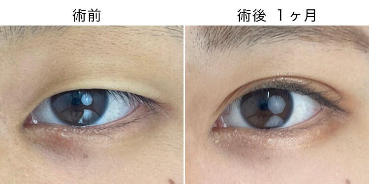 ぱっちり平行二重型