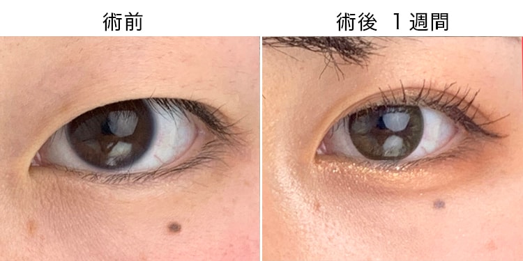 ナチュラル 末広二重型