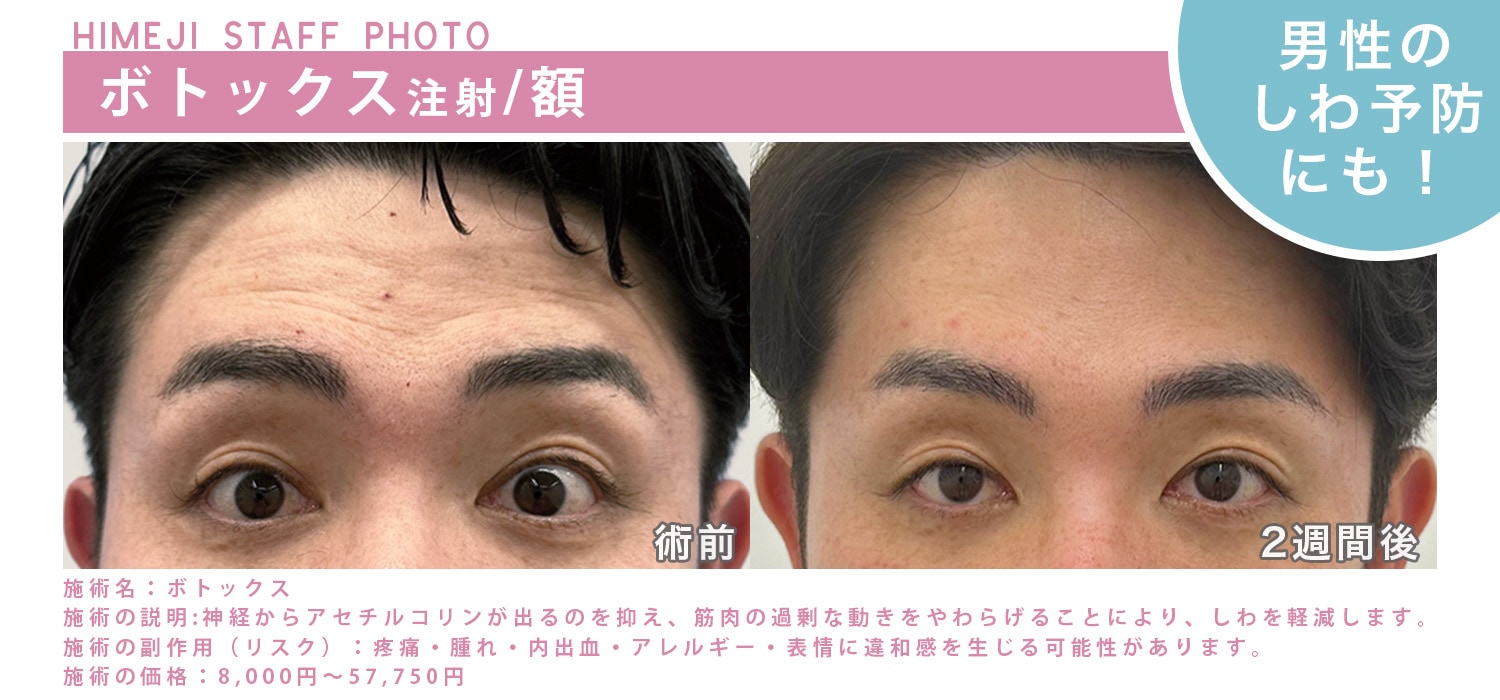 ボトックスが1500円⁉美容医療はじめの第一歩💖 - 姫路院, image size:1500x700