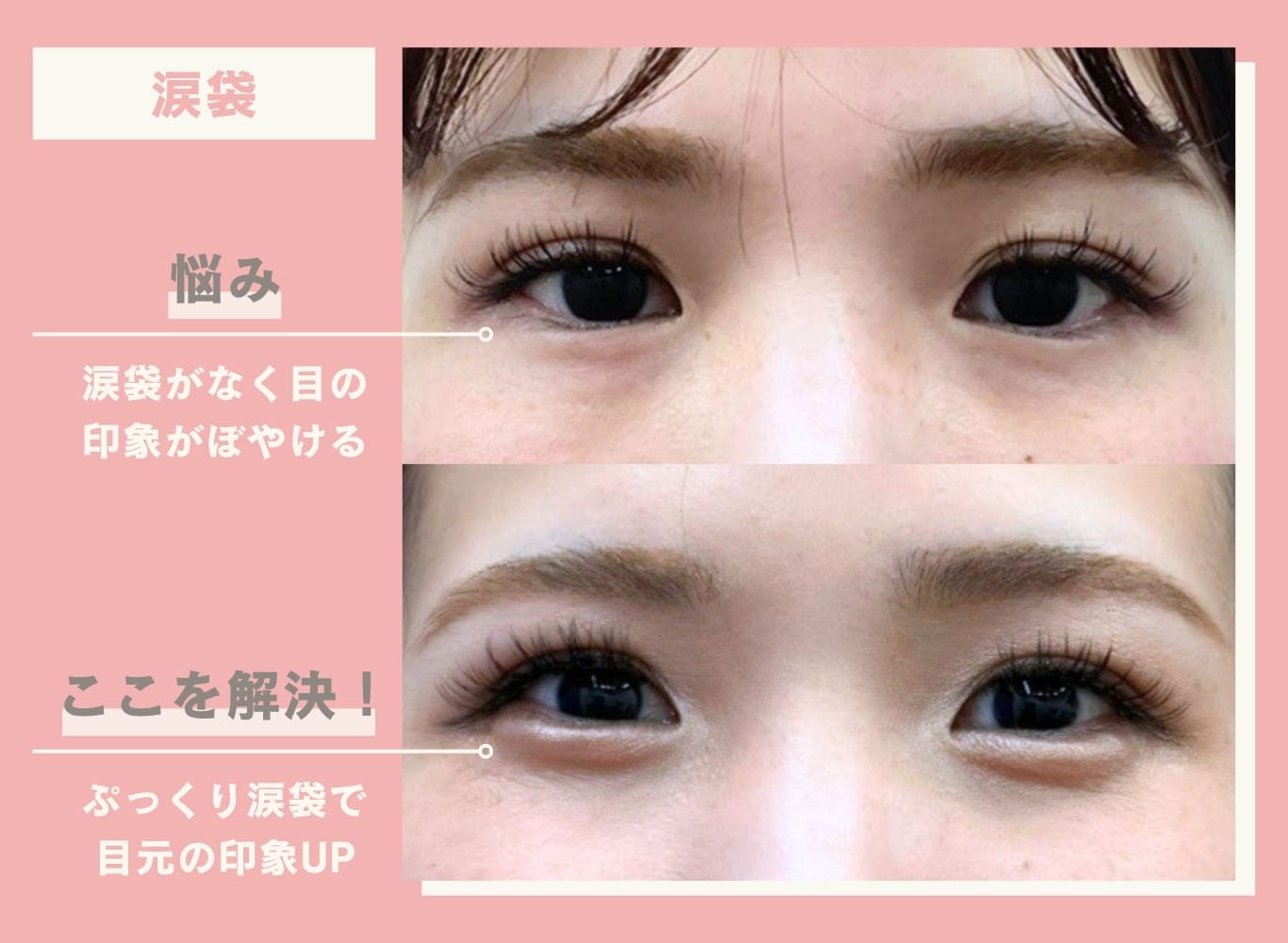 涙袋のヒアルロン酸