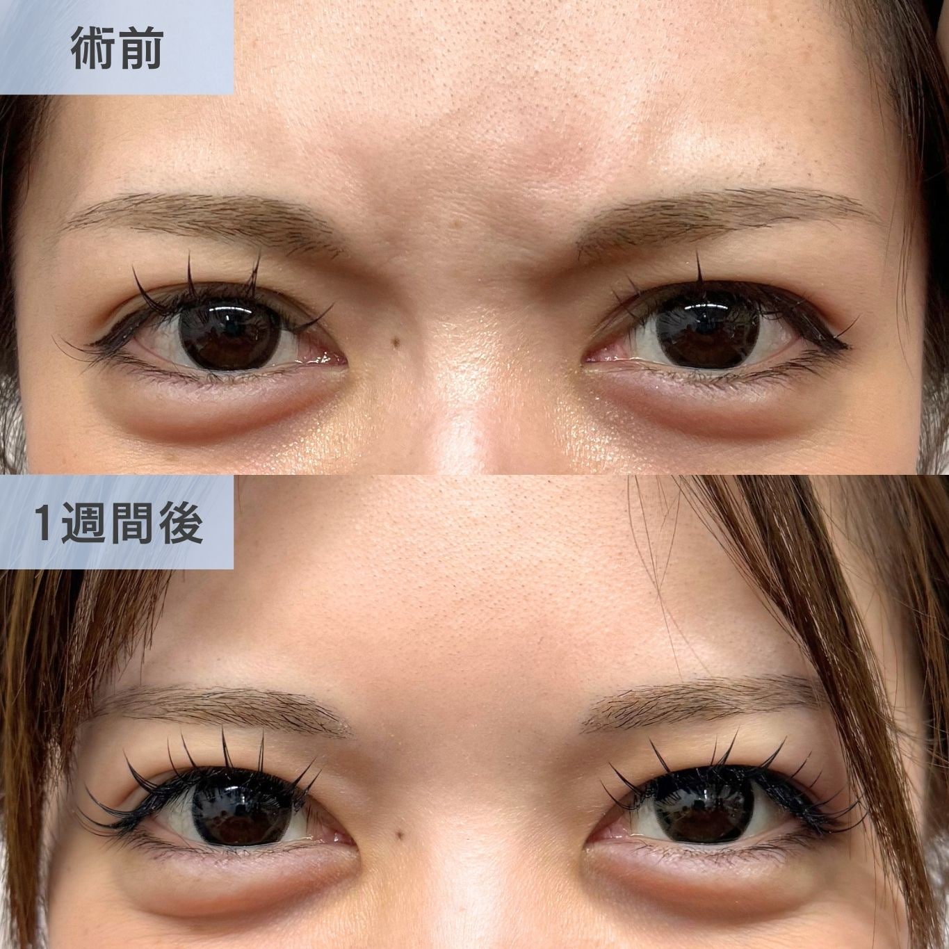 眉間ボトックス