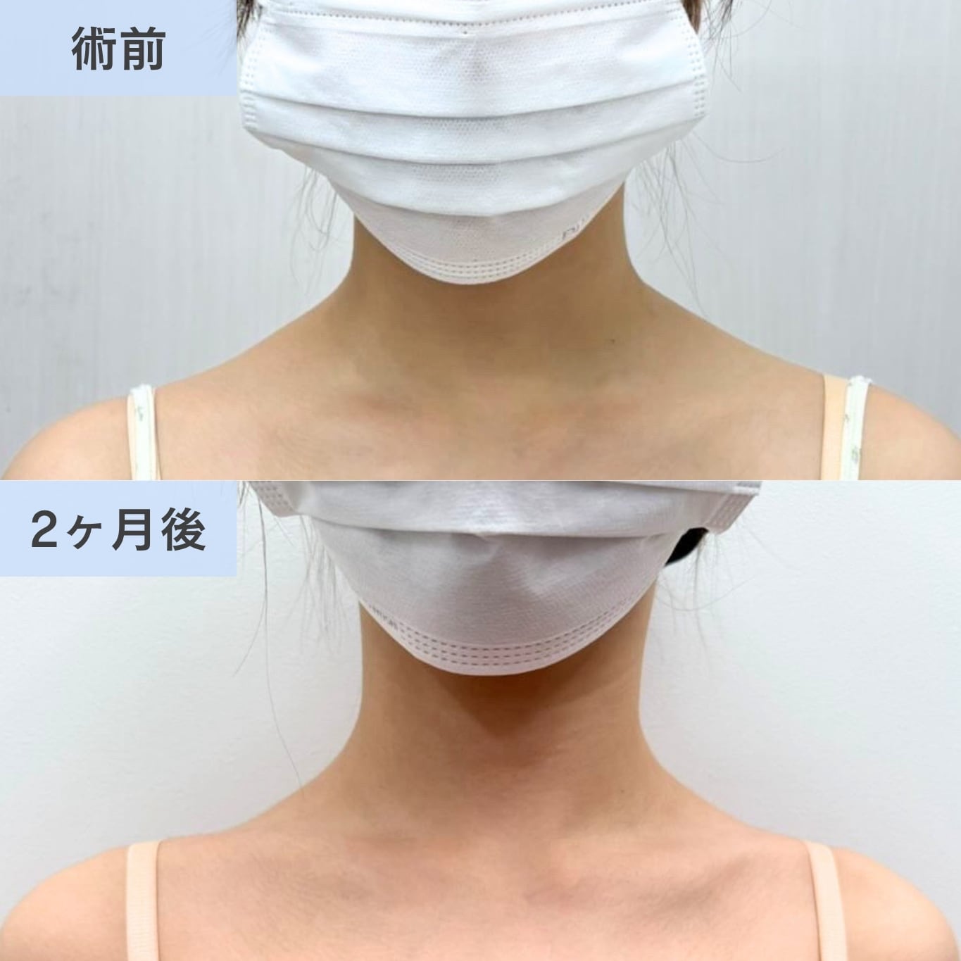 肩ボトックス