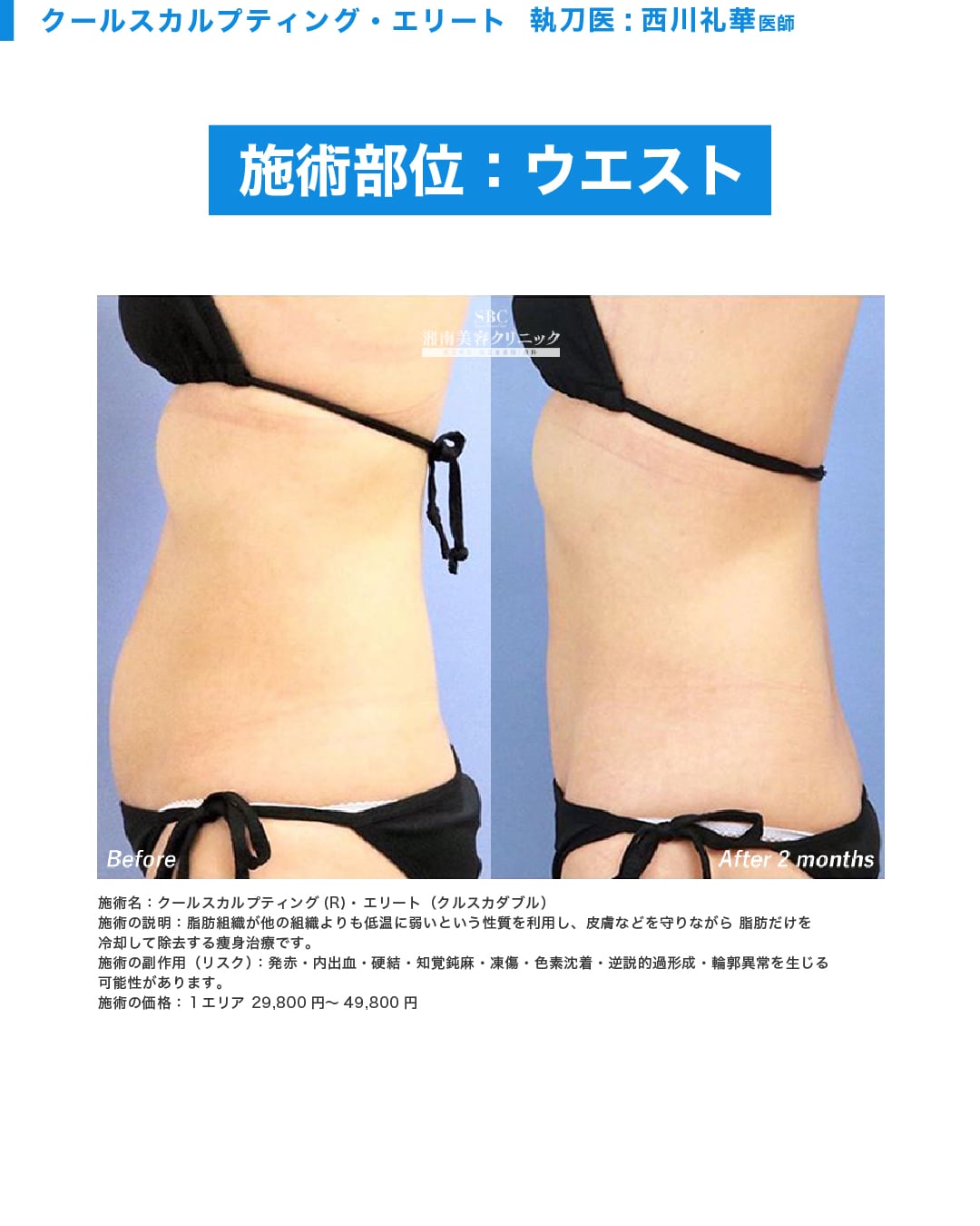 2017顔出しシミ付きパンツ 姫路院クルスカ徹底特集】 簡単ラク痩せクールスカルプティングエリートとは？脂肪撃退の最新メソッド！ - 姫路院