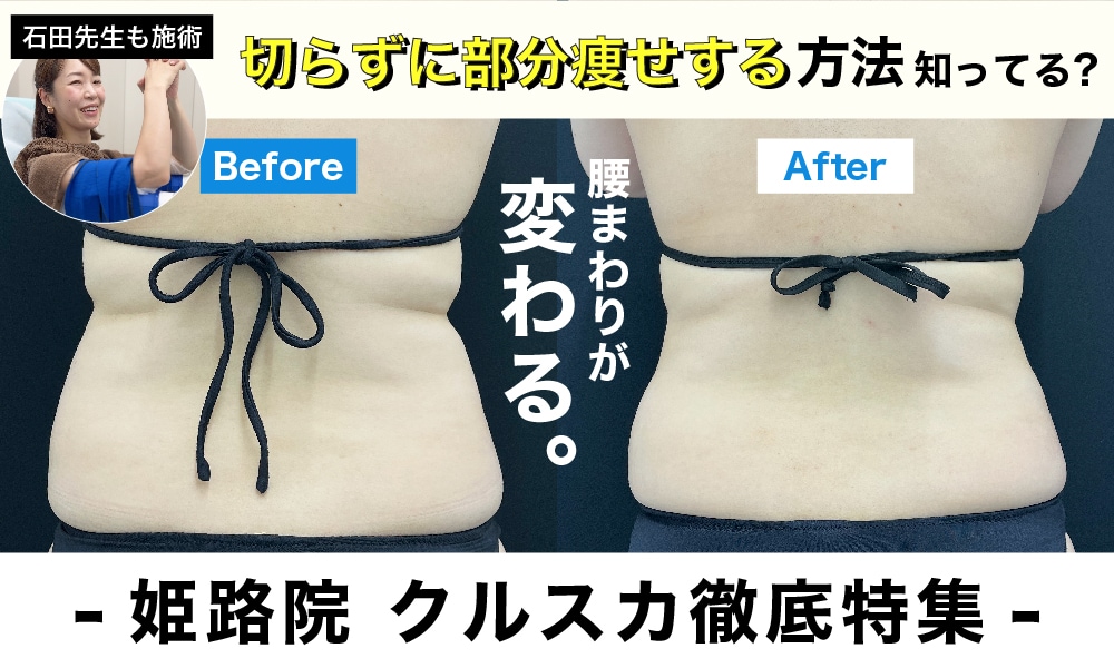 【姫路院クルスカ徹底特集】　簡単ラク痩せクールスカルプティングエリートとは？脂肪撃退の最新メソッド！
