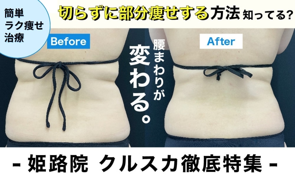 【姫路院クルスカ徹底特集】　簡単ラク痩せクールスカルプティングエリートとは？脂肪撃退の最新メソッド！